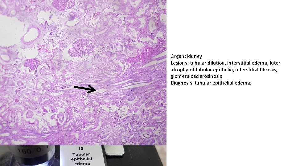 Organ: kidney Lesions: tubular dilation, interstitial edema, later atrophy of tubular epithelia, interstitial fibrosis,
