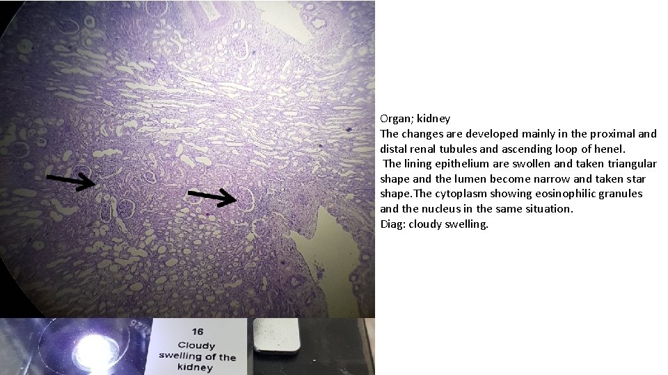 Organ; kidney The changes are developed mainly in the proximal and distal renal tubules