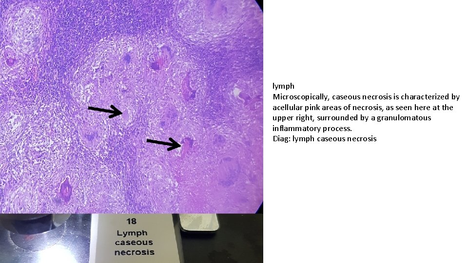 lymph Microscopically, caseous necrosis is characterized by acellular pink areas of necrosis, as seen