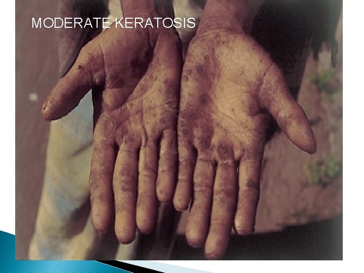 MODERATE KERATOSIS 