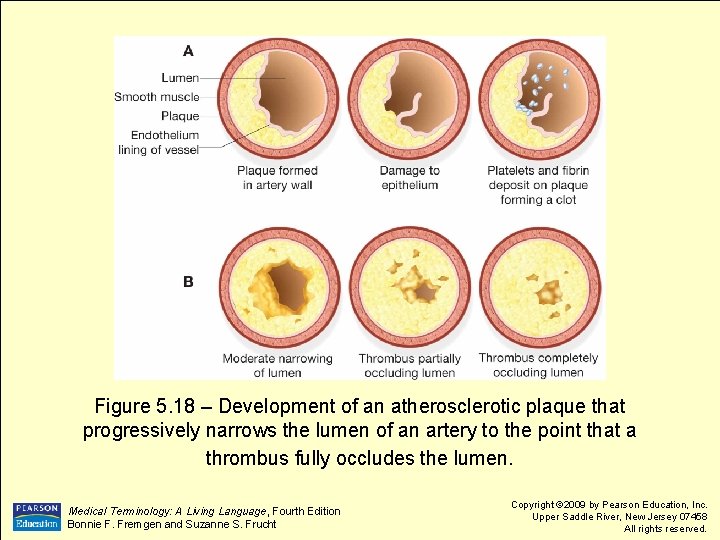 Figure 5. 18 – Development of an atherosclerotic plaque that progressively narrows the lumen