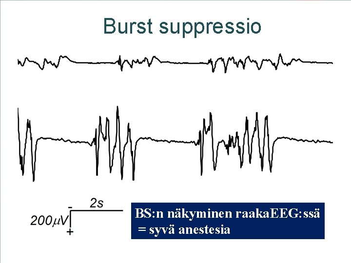 Burst suppressio aikuinen lapsi BS: n näkyminen raaka. EEG: ssä = syvä anestesia 