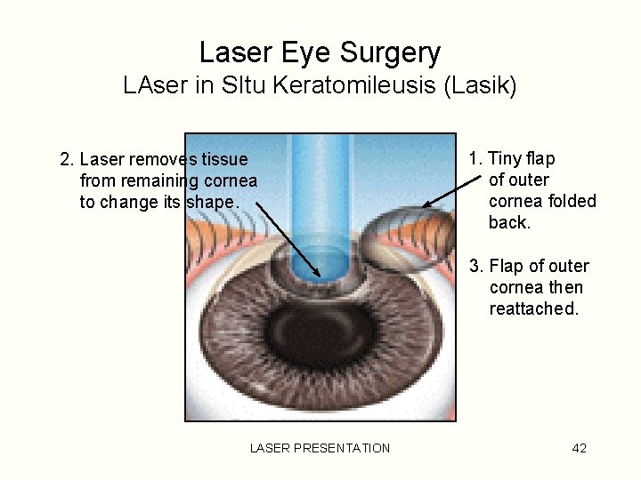 Laser Eye Surgery LAser in SItu Keratomileusis (Lasik) 2. Laser removes tissue from remaining