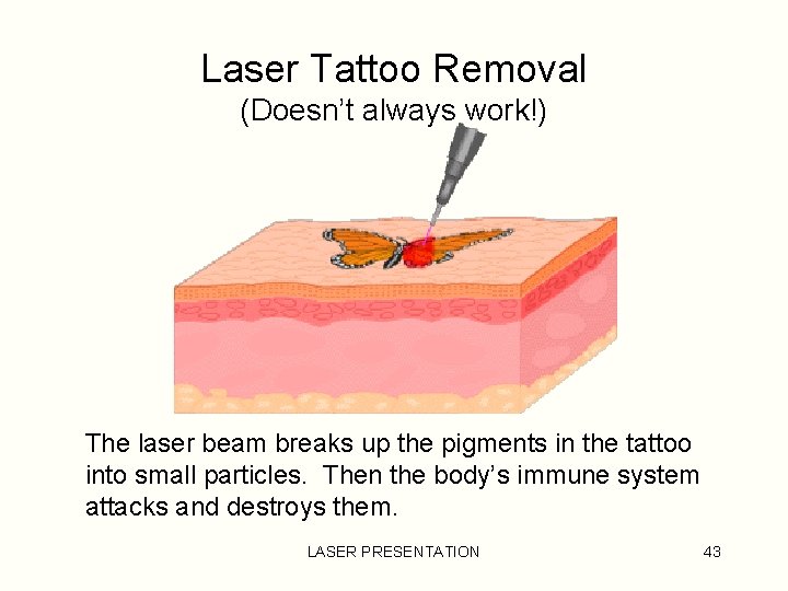 Laser Tattoo Removal (Doesn’t always work!) The laser beam breaks up the pigments in