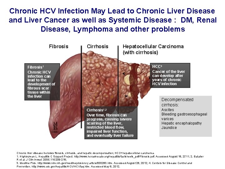 Chronic HCV Infection May Lead to Chronic Liver Disease and Liver Cancer as well Chronic HCV Infection May Lead to Chronic Liver Disease and Liver Cancer as well