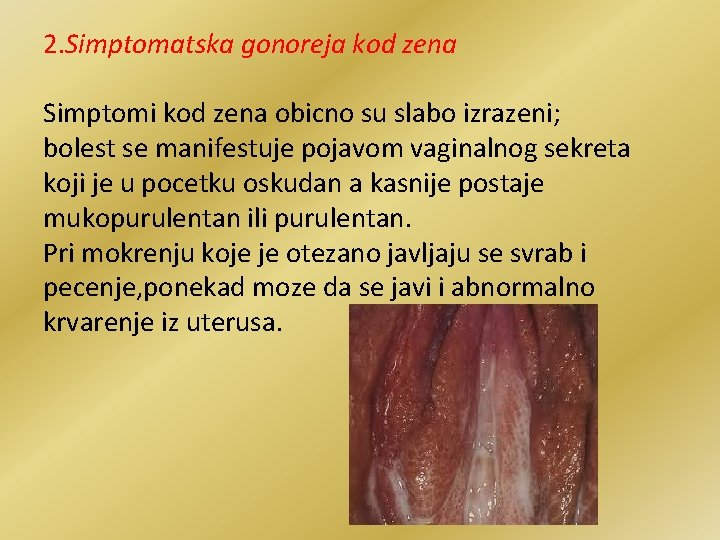 2. Simptomatska gonoreja kod zena Simptomi kod zena obicno su slabo izrazeni; bolest se