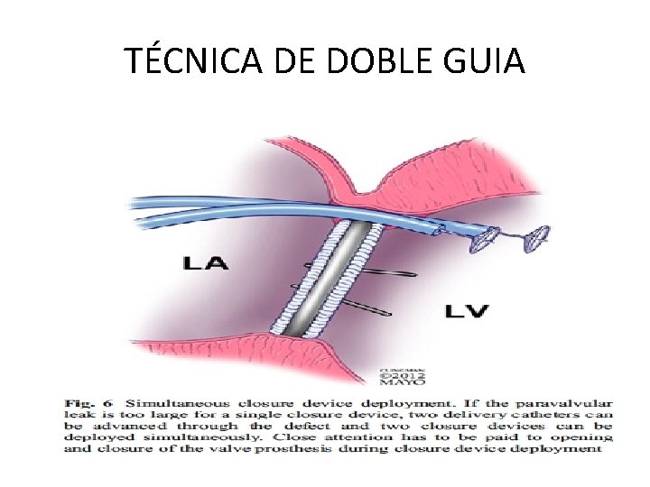 TÉCNICA DE DOBLE GUIA 