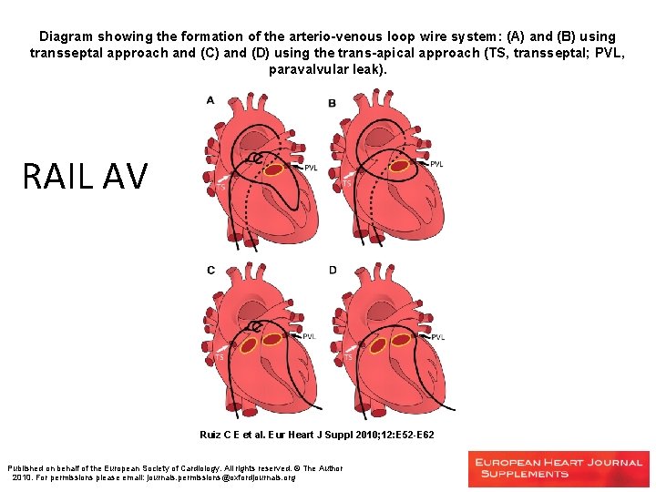 Diagram showing the formation of the arterio-venous loop wire system: (A) and (B) using