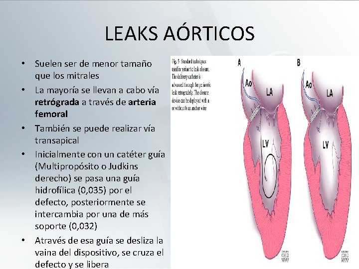 LEAKS AÓRTICOS • Suelen ser de menor tamaño que los mitrales • La mayoría