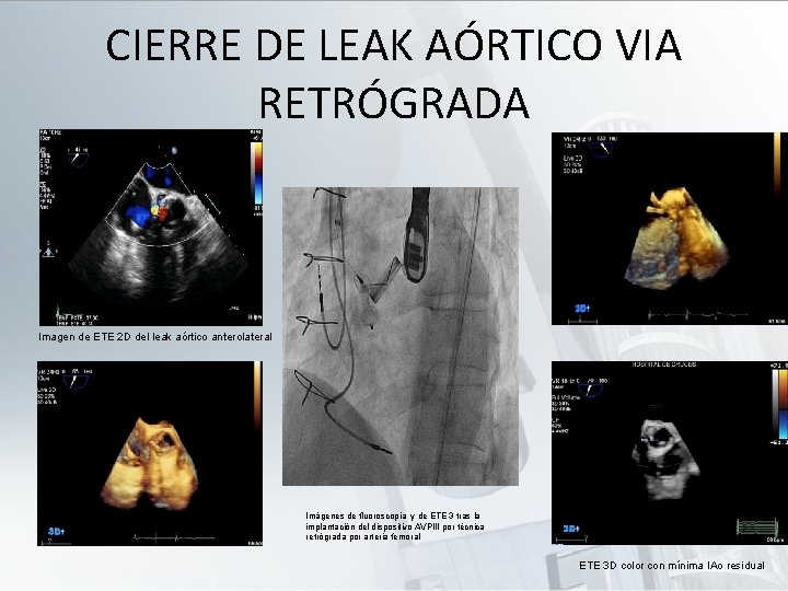 CIERRE DE LEAK AÓRTICO VIA RETRÓGRADA Imagen de ETE 2 D del leak aórtico