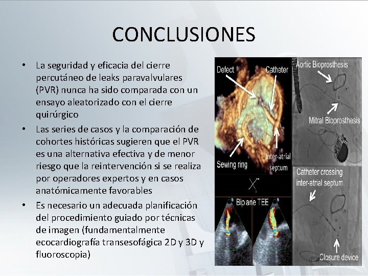 CONCLUSIONES • La seguridad y eficacia del cierre percutáneo de leaks paravalvulares (PVR) nunca