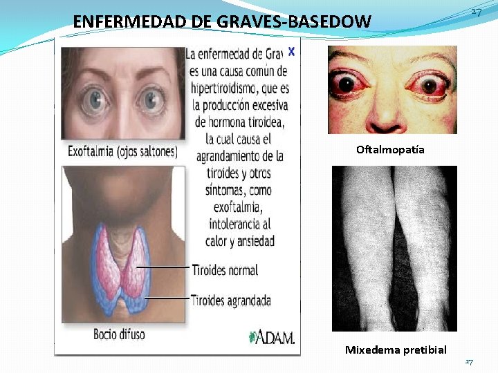 ENFERMEDAD DE GRAVES-BASEDOW 27 Oftalmopatía Mixedema pretibial 27 