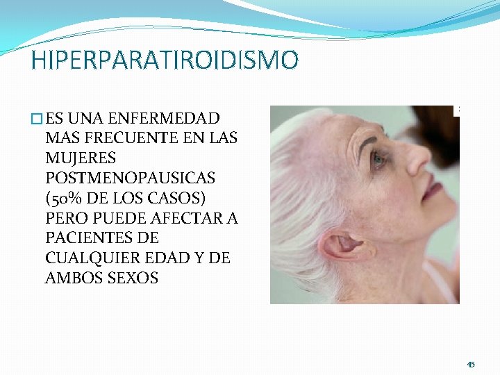 HIPERPARATIROIDISMO � ES UNA ENFERMEDAD MAS FRECUENTE EN LAS MUJERES POSTMENOPAUSICAS (50% DE LOS