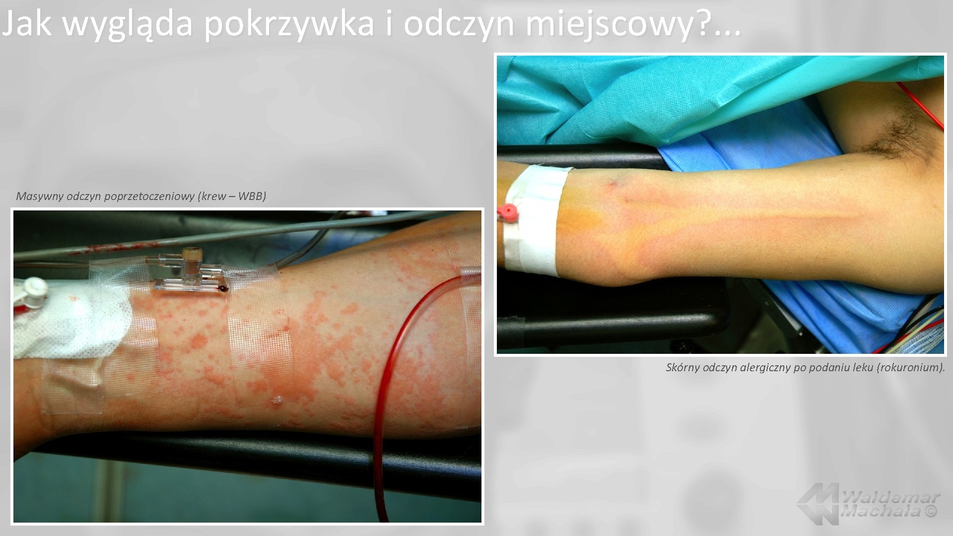 Jak wygląda pokrzywka i odczyn miejscowy? . . . Masywny odczyn poprzetoczeniowy (krew –