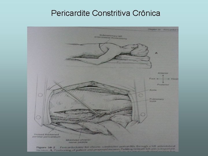 Pericardite Constritiva Crônica 