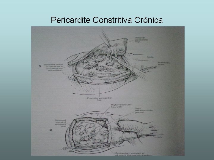 Pericardite Constritiva Crônica 