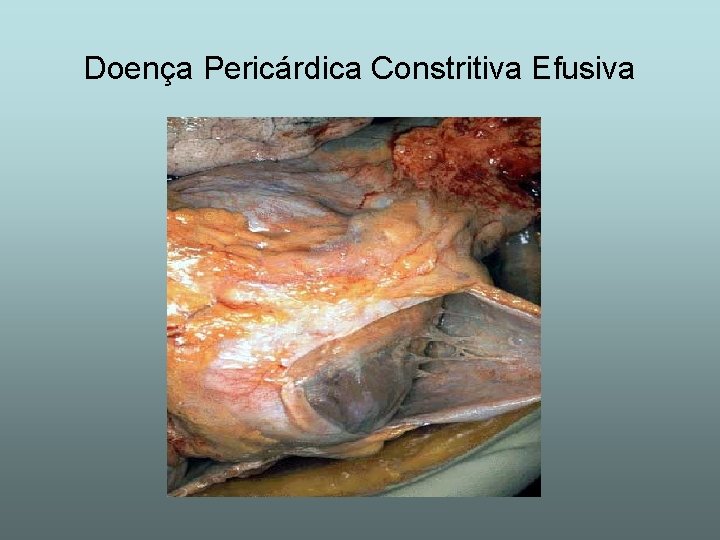 Doença Pericárdica Constritiva Efusiva 