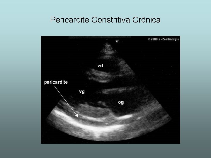 Pericardite Constritiva Crônica 