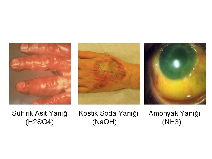 Sülfirik Asit Yanığı (H 2 SO 4) Kostik Soda Yanığı (Na. OH) Amonyak Yanığı
