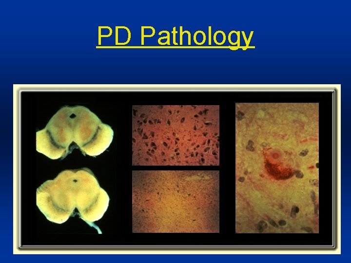 PD Pathology 