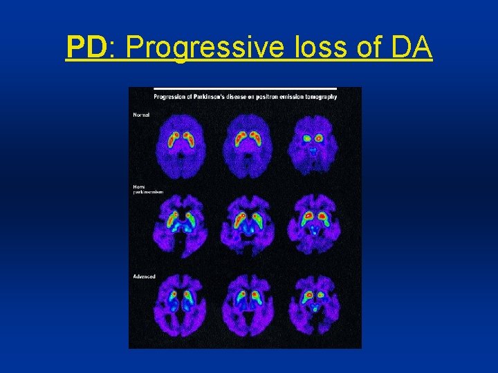 PD: Progressive loss of DA 