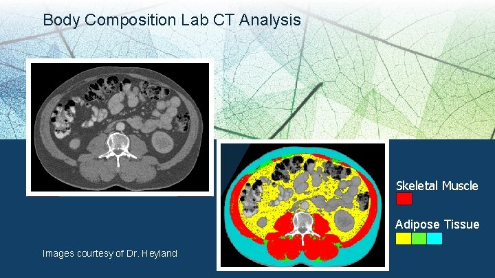 Body Composition Lab CT Analysis Skeletal Muscle Adipose Tissue Images courtesy of Dr. Heyland