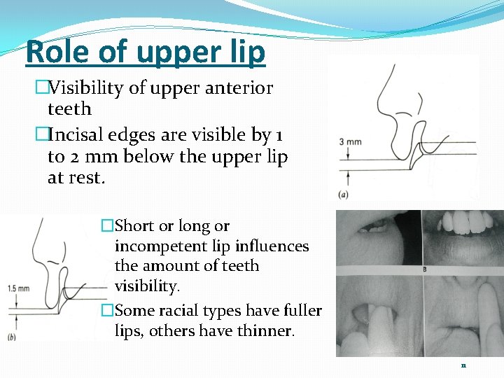 Role of upper lip �Visibility of upper anterior teeth �Incisal edges are visible by