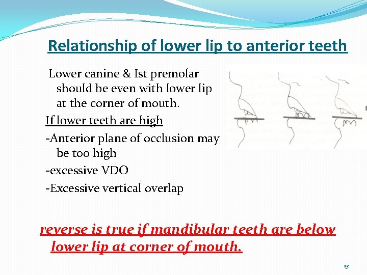 Relationship of lower lip to anterior teeth Lower canine & Ist premolar should be