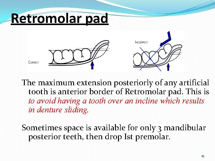 Retromolar pad The maximum extension posteriorly of any artificial tooth is anterior border of