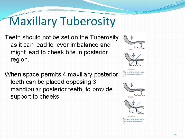 Maxillary Tuberosity Teeth should not be set on the Tuberosity as it can lead
