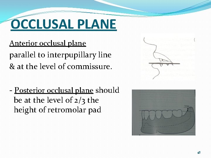 OCCLUSAL PLANE Anterior occlusal plane parallel to interpupillary line & at the level of