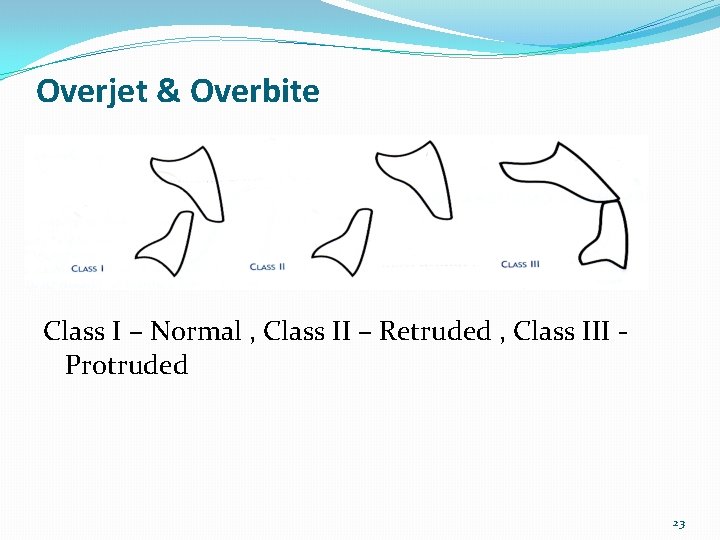 Overjet & Overbite Class I – Normal , Class II – Retruded , Class