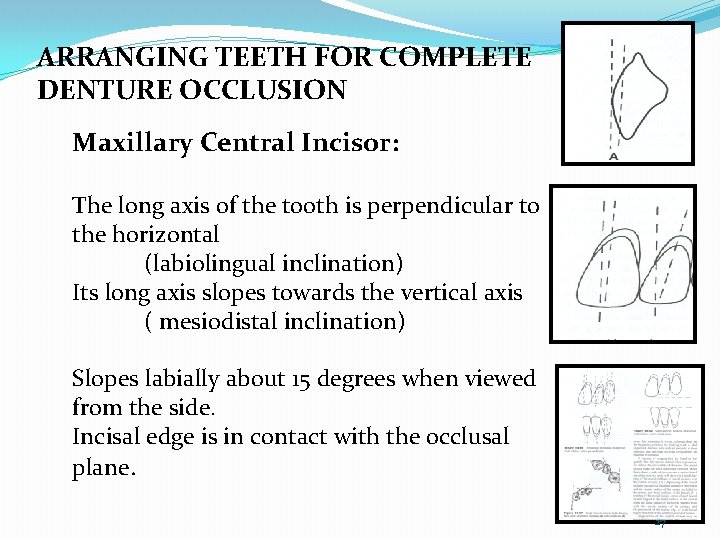 ARRANGING TEETH FOR COMPLETE DENTURE OCCLUSION Maxillary Central Incisor: The long axis of the