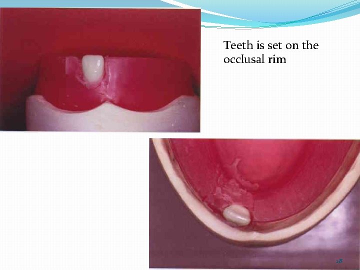 Teeth is set on the occlusal rim 28 