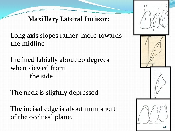 Maxillary Lateral Incisor: Long axis slopes rather more towards the midline Inclined labially about