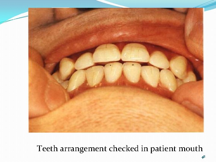 Teeth arrangement checked in patient mouth 48 