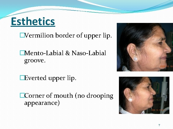 Esthetics �Vermilion border of upper lip. �Mento-Labial & Naso-Labial groove. �Everted upper lip. �Corner