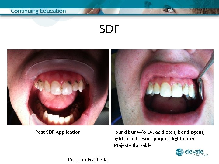 SDF Post SDF Application Dr. John Frachella round bur w/o LA, acid etch, bond