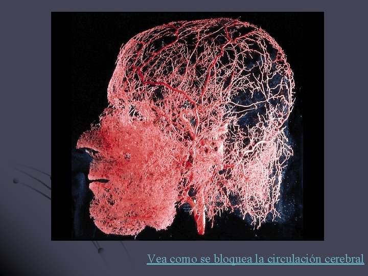 Vea como se bloquea la circulación cerebral Vea como se bloquea la circulación cerebral