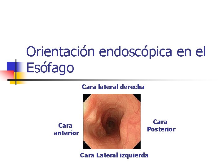 Orientación endoscópica en el Esófago Cara lateral derecha Cara anterior Cara Posterior Cara Lateral