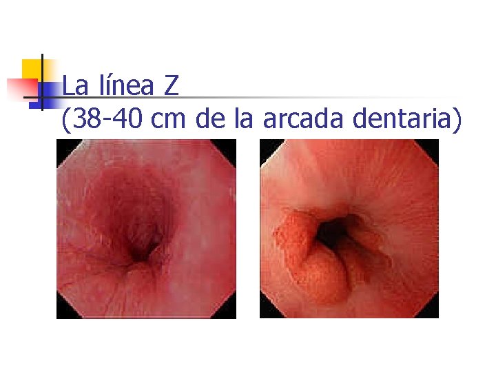 La línea Z (38 -40 cm de la arcada dentaria) 
