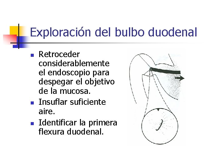Exploración del bulbo duodenal n n n Retroceder considerablemente el endoscopio para despegar el