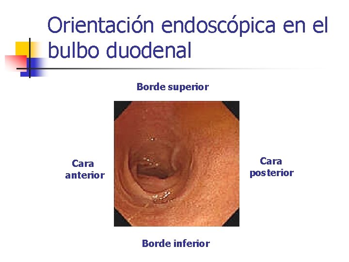 Orientación endoscópica en el bulbo duodenal Borde superior Cara posterior Cara anterior Borde inferior