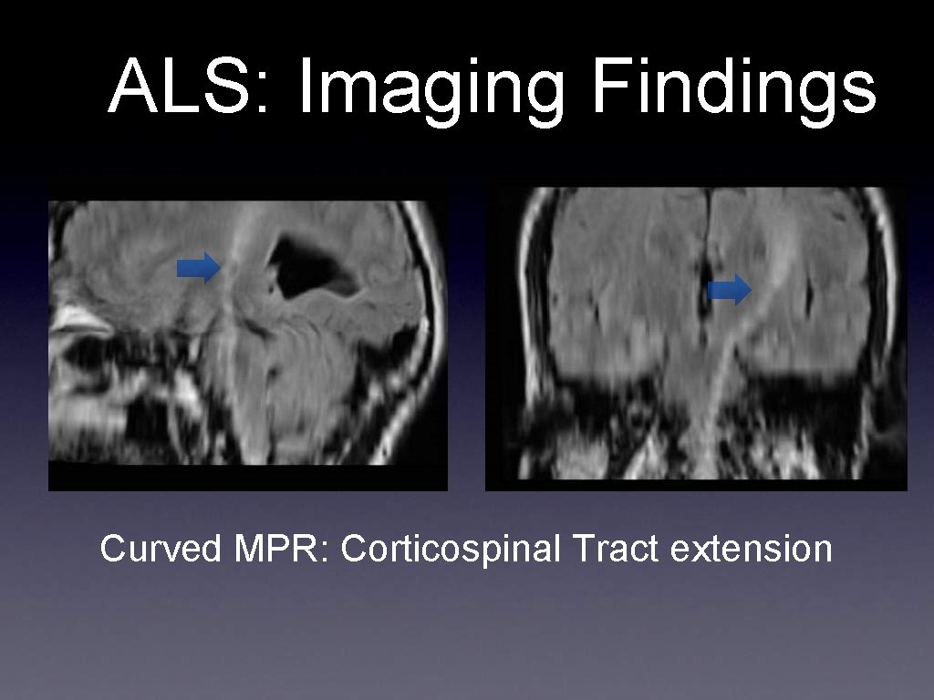 ALS: Imaging Findings Curved MPR: Corticospinal Tract extension 