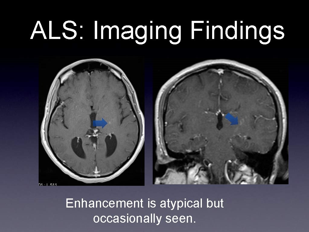 ALS: Imaging Findings Enhancement is atypical but occasionally seen. 