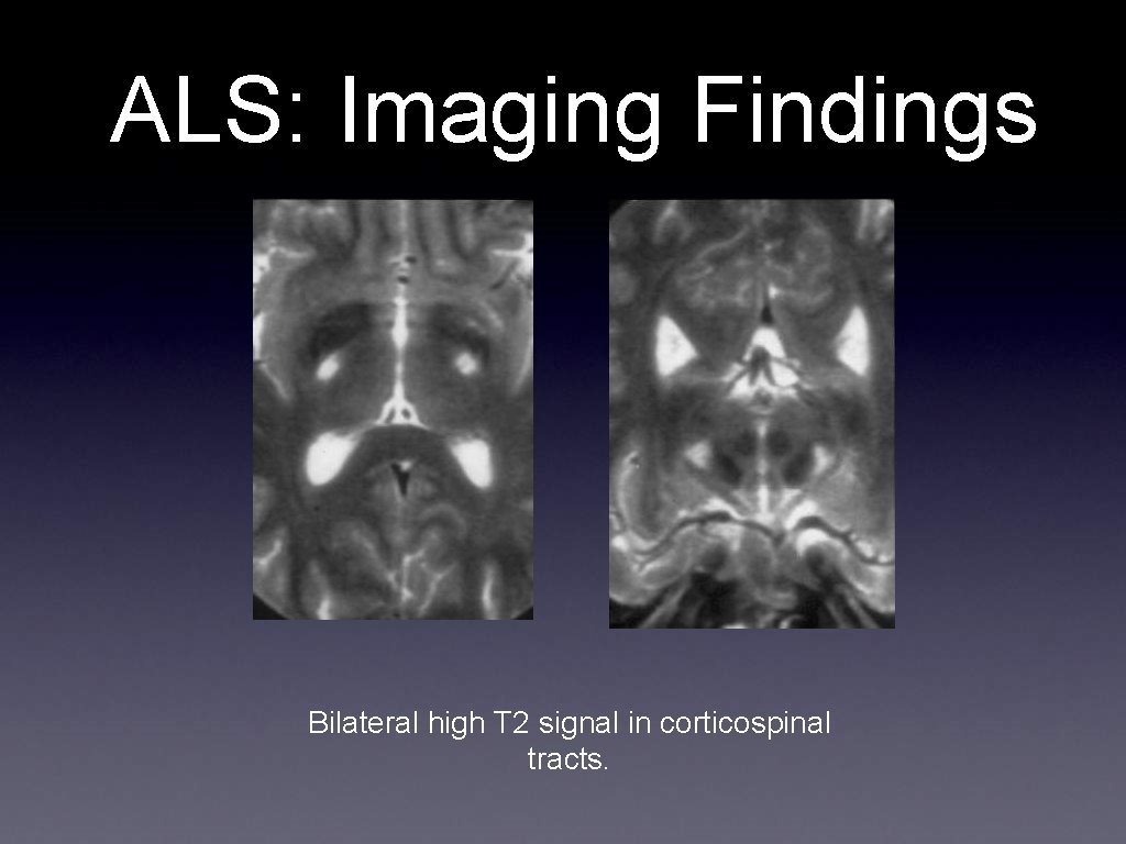 ALS: Imaging Findings Bilateral high T 2 signal in corticospinal tracts. 