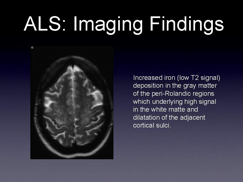 ALS: Imaging Findings Increased iron (low T 2 signal) deposition in the gray matter