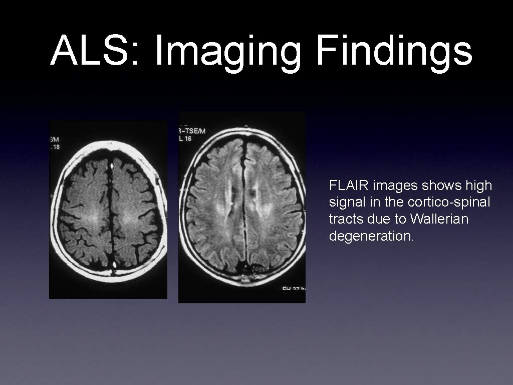 ALS: Imaging Findings FLAIR images shows high signal in the cortico-spinal tracts due to