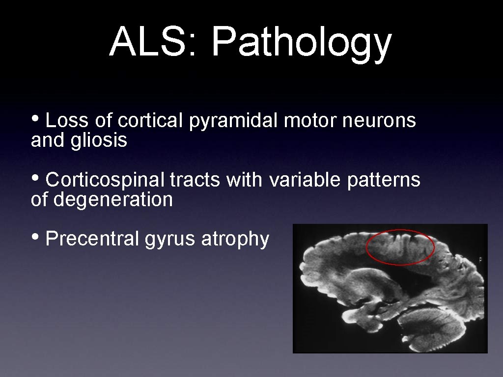 ALS: Pathology • Loss of cortical pyramidal motor neurons and gliosis • Corticospinal tracts