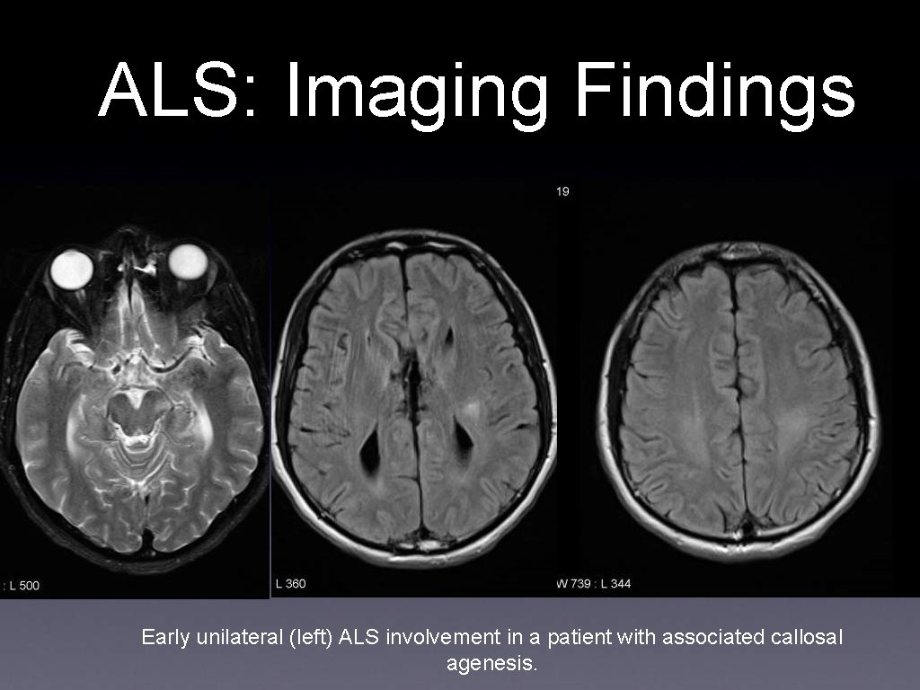 ALS: Imaging Findings Early unilateral (left) ALS involvement in a patient with associated callosal